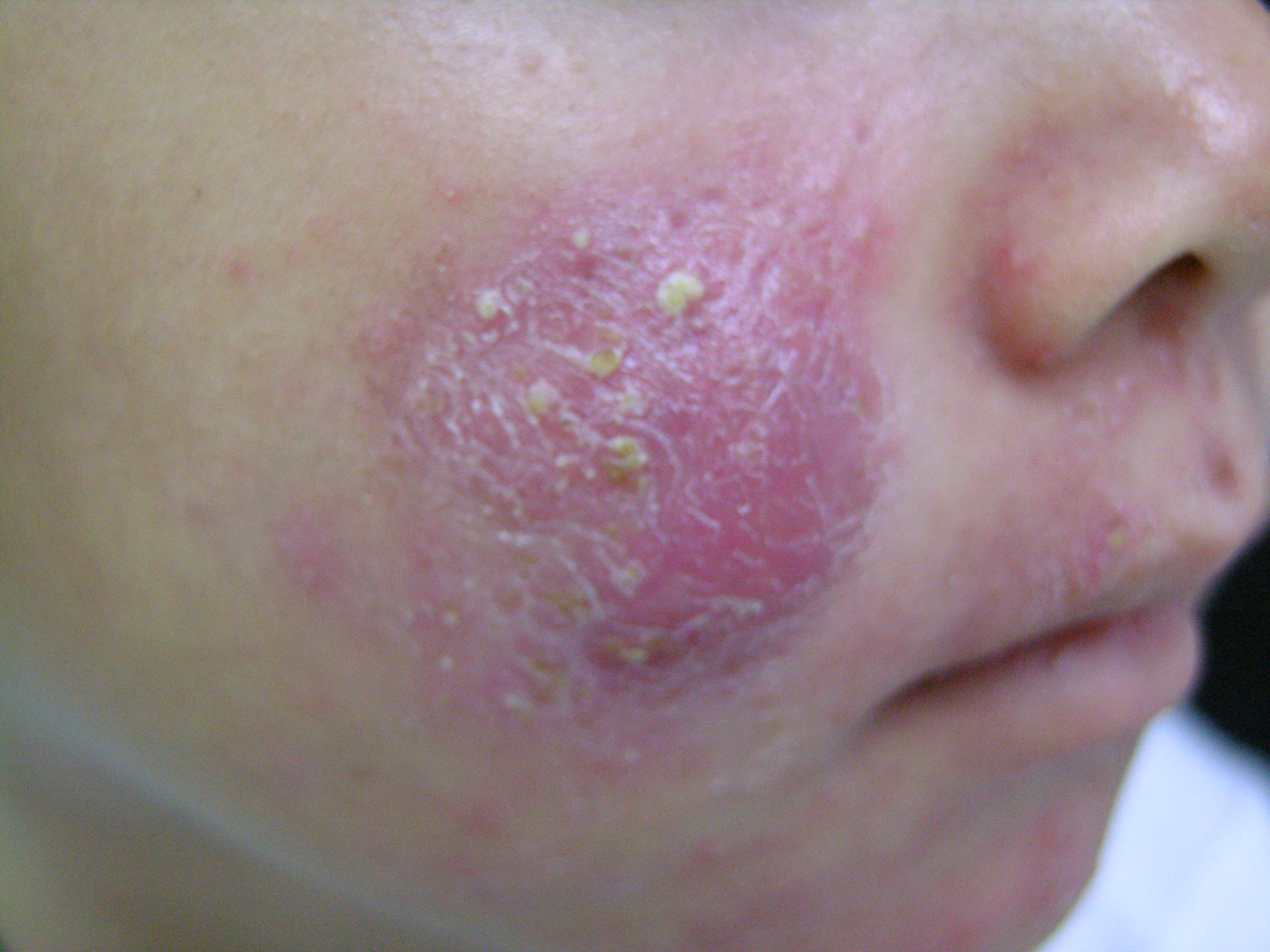 Perioral Dermatitis Picture Image on MedicineNet.com