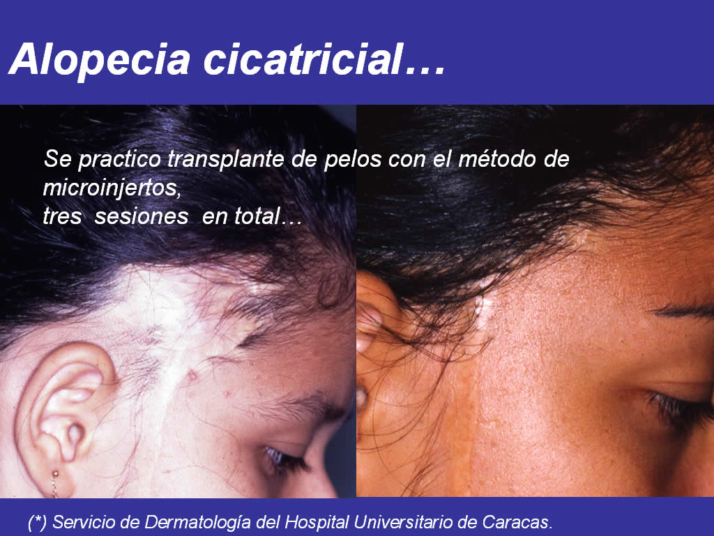 Cicatrical Alopecia on Alopecia Cicatricial