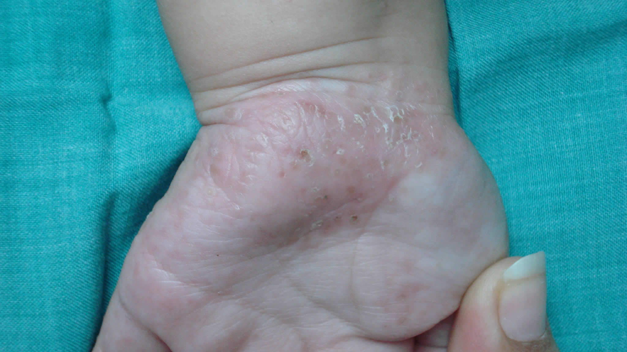 Acropustulosis of Infancy - Medscape