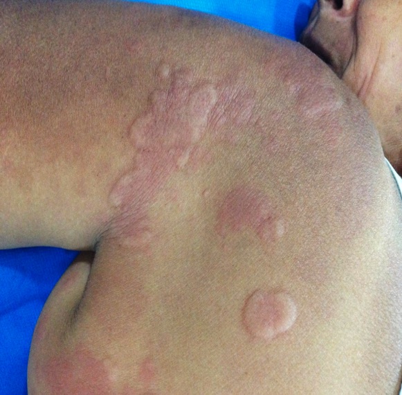 Urticaria Cr Nica Y Autoinmunidad Piel L Latinoamericana