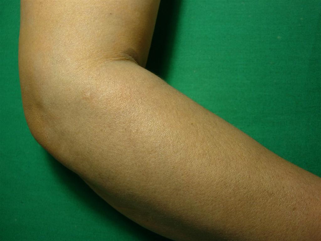 Dermatitis cenicienta – PIEL-L Latinoamericana