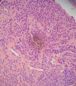 detalle-tumor-glomico