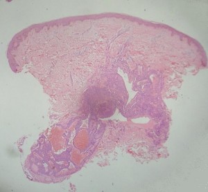 tumor-glomico-panoramica