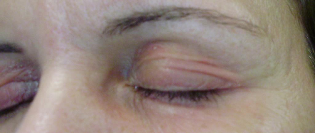 Dermatitis por contacto en parpados: alergia al níquel o a cosméticos –  PIEL-L Latinoamericana