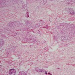 histologicas-de-granuloma-post-herpes-1600x1200