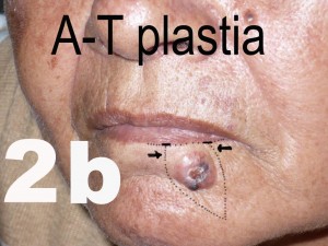 2b  A-Tplastia