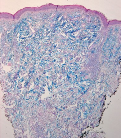 Figura 7 Lupus Tumido. Tinción de hierro coloidal muestra incremento de mucopolisacàridos entre  la  colágena