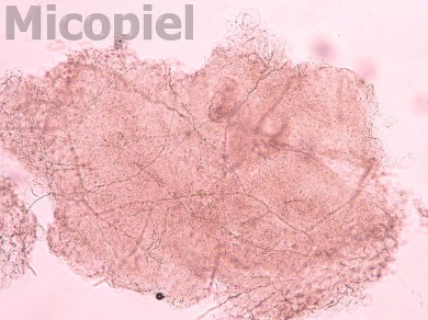 Fig.16: Examen directo con KOH al 10% observándose abundantes hifas hialinas en las escamas examinadas (200x)