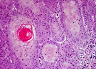 Los queratinocitos son grandes, particularmente hacia el centro de los nidos de las células tumorales, rodeados por un collarete de células basales (HE 20X)