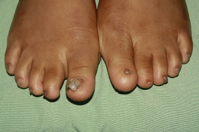 Fig.2: Pies: hipoplasia bilateral de las 10 uñas uñas de los pies. 