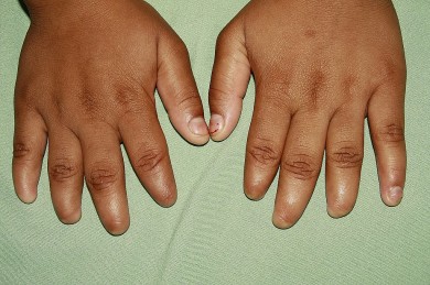 Fig.1: Manos: ausencia  de las uñas del 2do al 5to ortejo  de mano derecha y del 2do al 4to ortejo de mano izquierda 