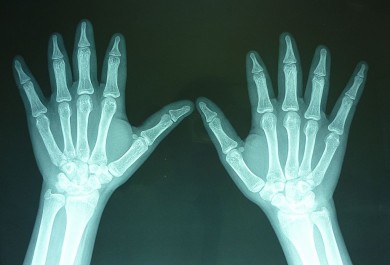 Fig.3: Radiografías AP de manos: Ausencia de la 2da falange del 2do, 3er y 4to dedo observándose la falange distal en forma de punta de lápiz 
