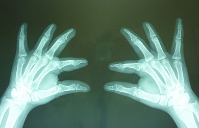 Fig.4: Radiografías oblicua  de manos: Ausencia de la 2da falange del 2do, 3er y 4to dedo observándose la falange distal en forma de punta de lápiz