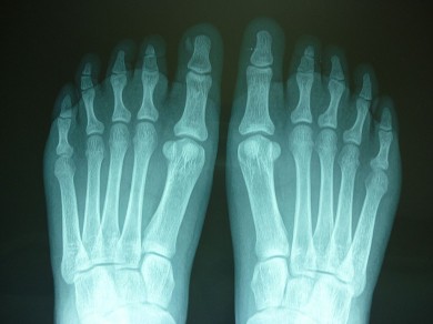 Fig.5: Radiografías AP pies: ausencia de la 2da falange del 3er dedo bilateral y fusión de las falanges distales 4to y 5to dedo del pie izquierdo