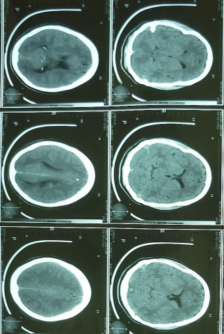 Fig.6: T C cerebral: no se evidencia patología cerebral demostrable por este método diagnóstico. Sistema  ventricular conservado. 