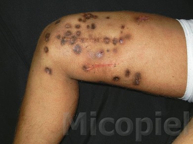 Fig. 1: Cicatriz superior fue la del lipoma (1998) y la inferior de la biopsia (2013)