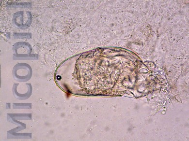 Fig. 8: Después de 3 a 4 días se produce la eclosión del huevo de Sarcoptes scabiei var. hominis emergiendo la larva del ácaro