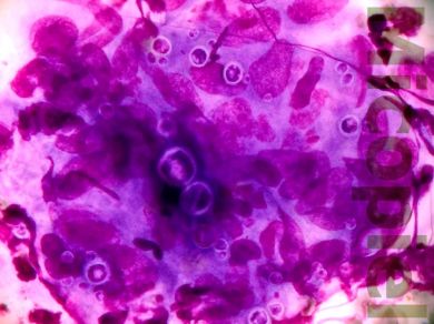 Fig. 7: Entendido con tinción de Giemsa, macrófagos y blastoconidios multibrotaantes