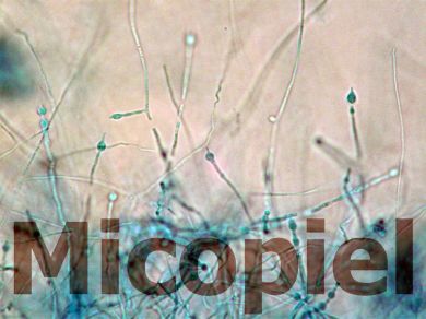 Fig.9: Microscopía del cultivo en agar coco con tinción de lactofenol, clamidoconidios característicos de Paracoccidioides brasiliensis