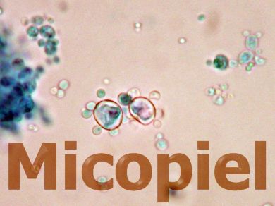Fig. 11 Microscopía del cultivo en agar coco con tinción de lactofenol, blastoconidios multibrotantes característicos de Paracoccidioides brasiliensis