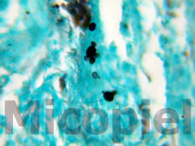 Fig. 16: Estudio histopatológico con tinción de metalamina argéntica de Grocott