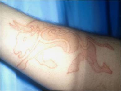 2-Inflamación, eritema y edema en el tatuaje con henna, observada a las 48 horas de aplicado el tatuaje (Di Prisco ycol 2006)