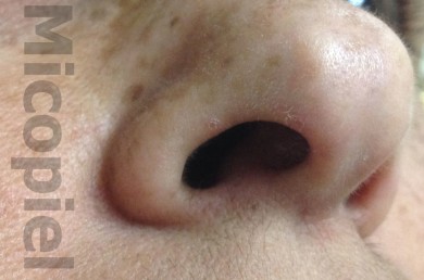 Fig. 16: Dos semanas de tratamiento. Imagen tomada por la paciente con su móvil y enviada vía WhatsApp. Todavía se aprecia leve descamación eritematosa en introito nasal derecho