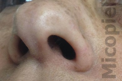 Fig. 17: Dos semanas de tratamiento. Imagen tomada por la paciente con su móvil y enviada vía WhatsApp