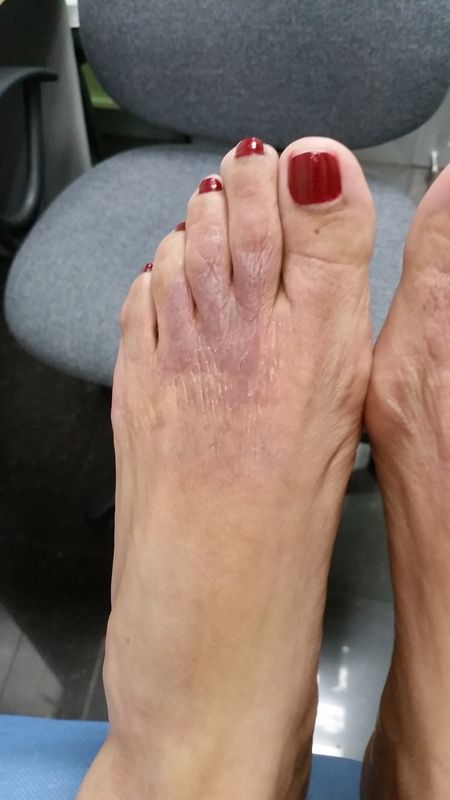 Dermatitis alérgica de Contacto al calzado. sensibilizaciones. A propósito de un caso – Latinoamericana