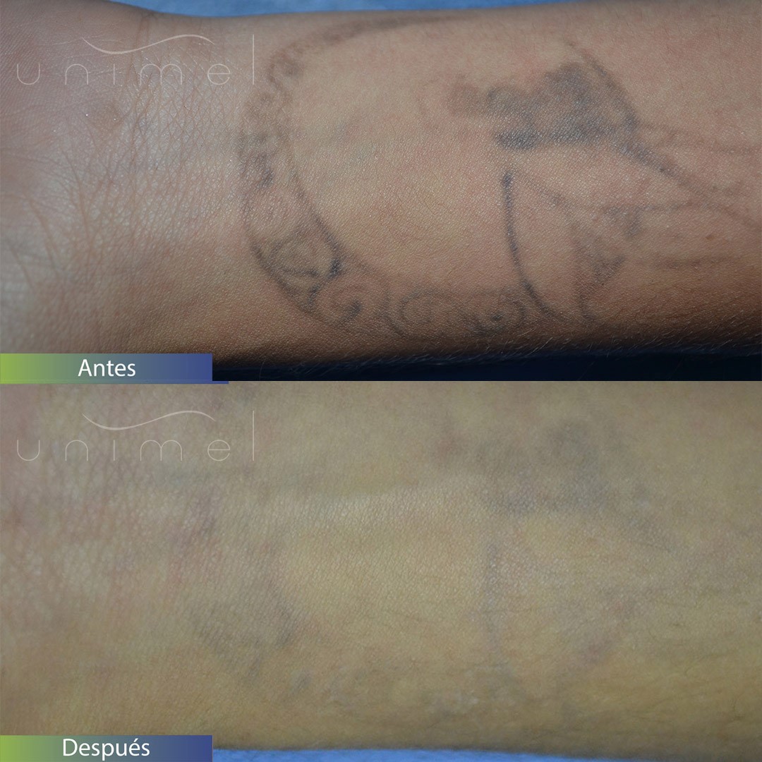 Eliminación de tatuajes con láser – PIEL-L Latinoamericana