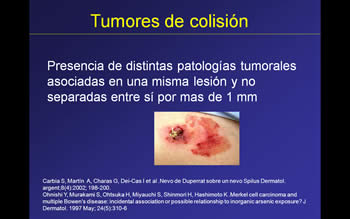 tumores.jpg