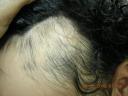 alopecias_html_m54f0fb09.jpg