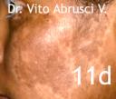 vitiligo-11d.jpg