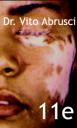 vitiligo-11e.jpg