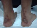 yidri-rivero-hsjd-a6674-dermatitis-calzado-mercapto-5.JPG