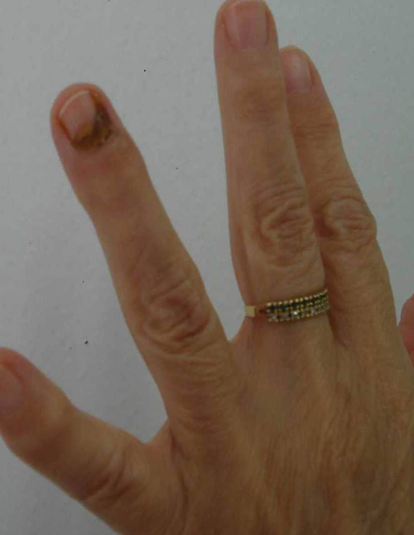 Assuntoonicopatia pro diagnose PIELL Latinoamericana