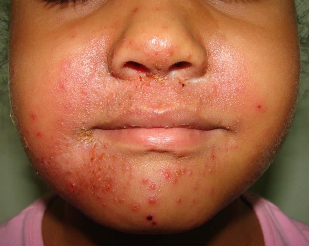 Perioral Dermatitis Vs Atopic Dermatitis