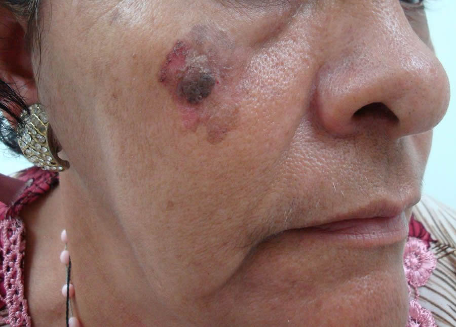 251- Consulta a un Colega Nº 6: Queratosis seborreica – PIEL-L