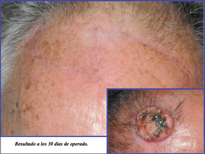 Carcinoma espinocelular en la frente PIELL Latinoamericana