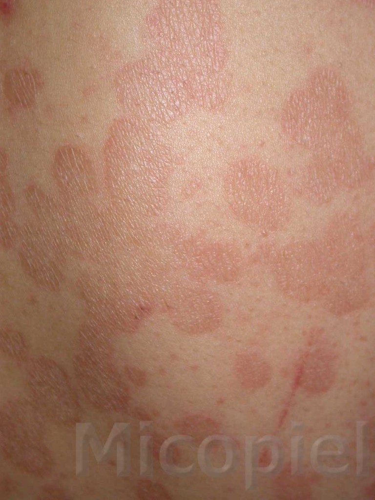Caso clínico Nº 46. Pitiriasis Versicolor – PIEL-L Latinoamericana