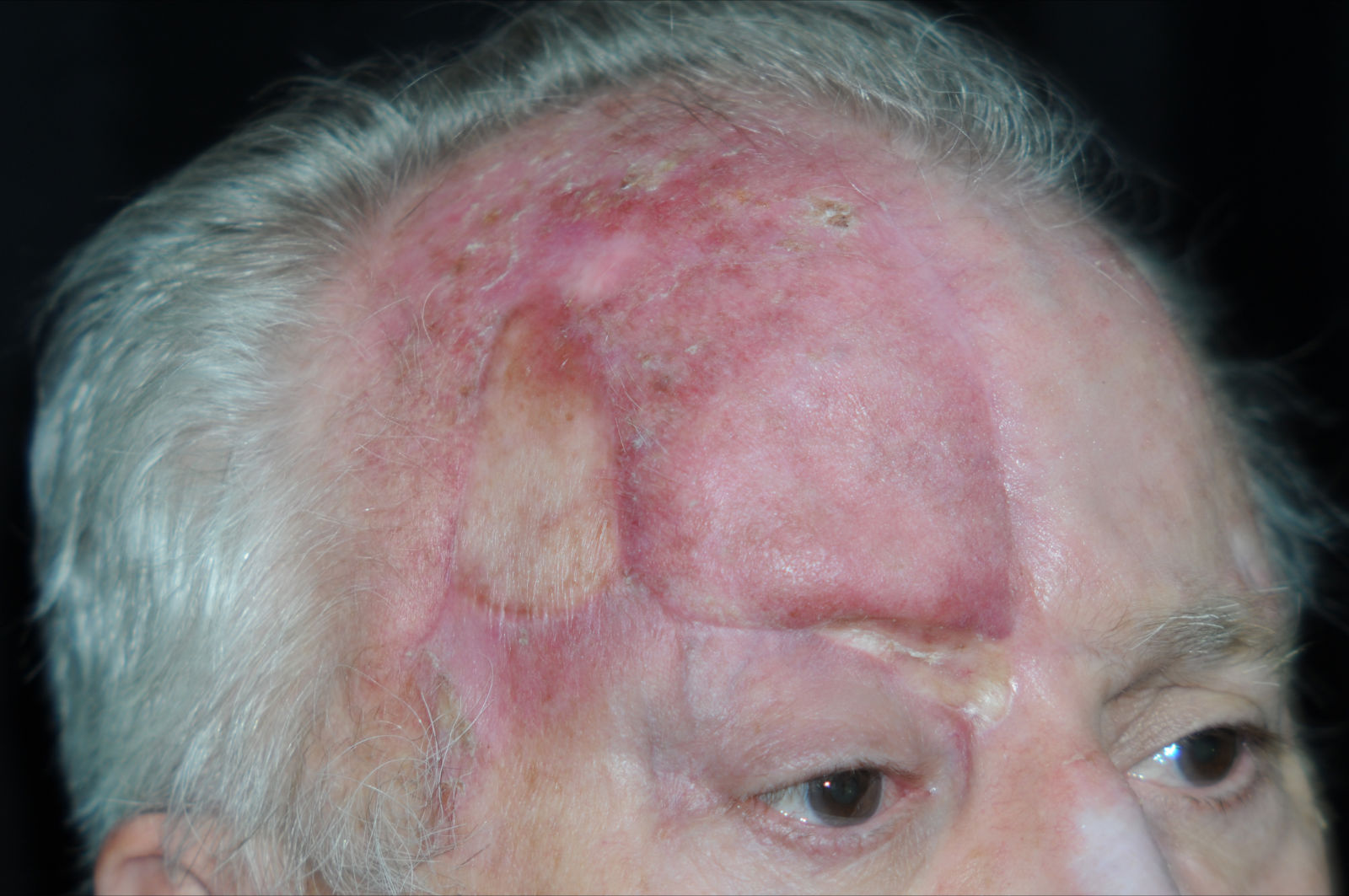 Carcinoma espinocelular recidivante en la frente PIELL Latinoamericana