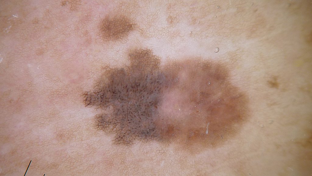 Dermatoscopia en el consultorio Edición 298: Caso para diagnóstico ...