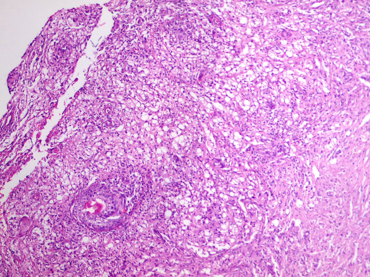 Ulceras por Criptococosis. Comportamiento en un paciente ...
