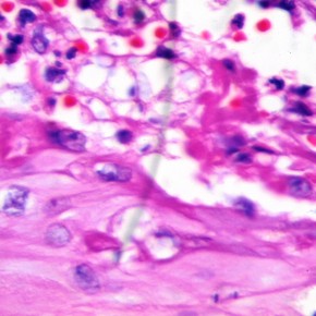 Ulceras por Criptococosis. Comportamiento en un paciente ...