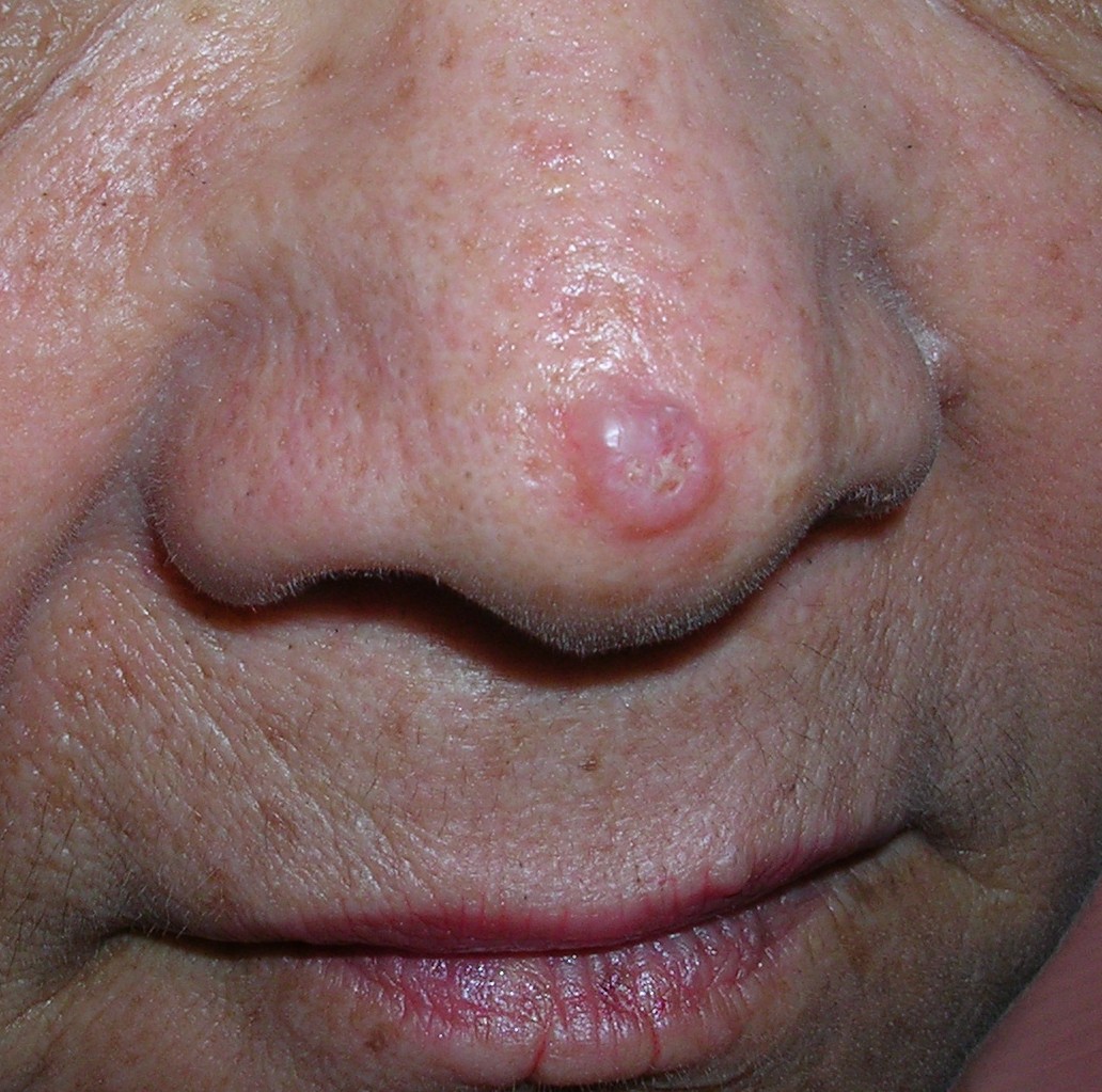 Caso Nº4 Ed.339: Dermatoscopía: carcinoma basocelular queratósico ...