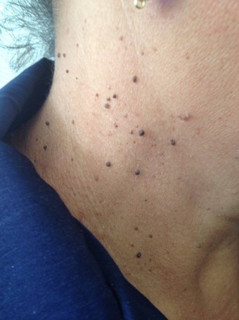 Acantosis nigricans e insulinoresistencia PIELL Latinoamericana