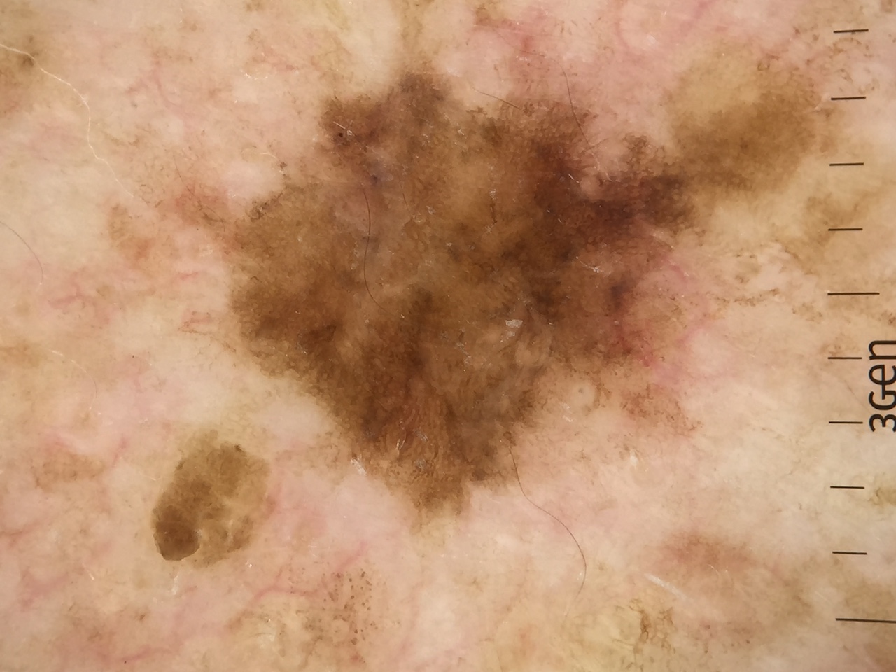 Dermatoscopia Edición Nº 462. Reto diagnóstico – PIEL-L Latinoamericana