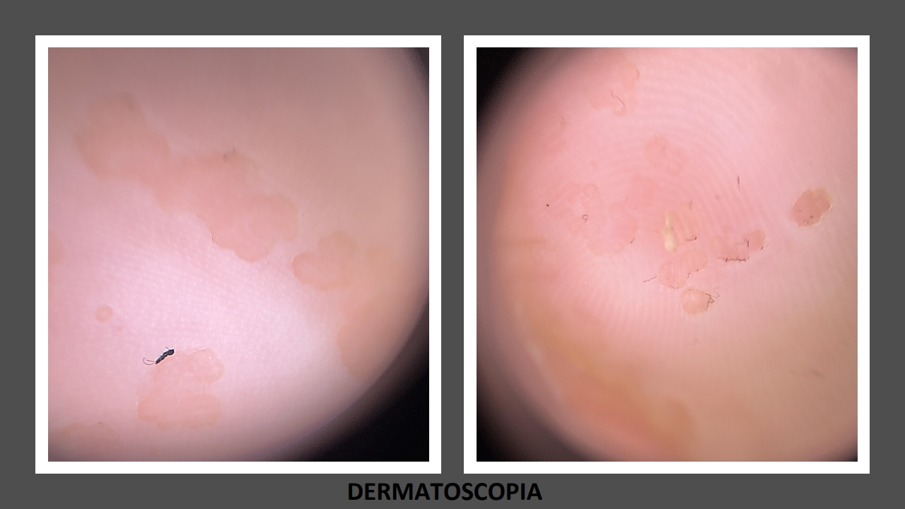 Queratolisis Puntata PIELL Latinoamericana