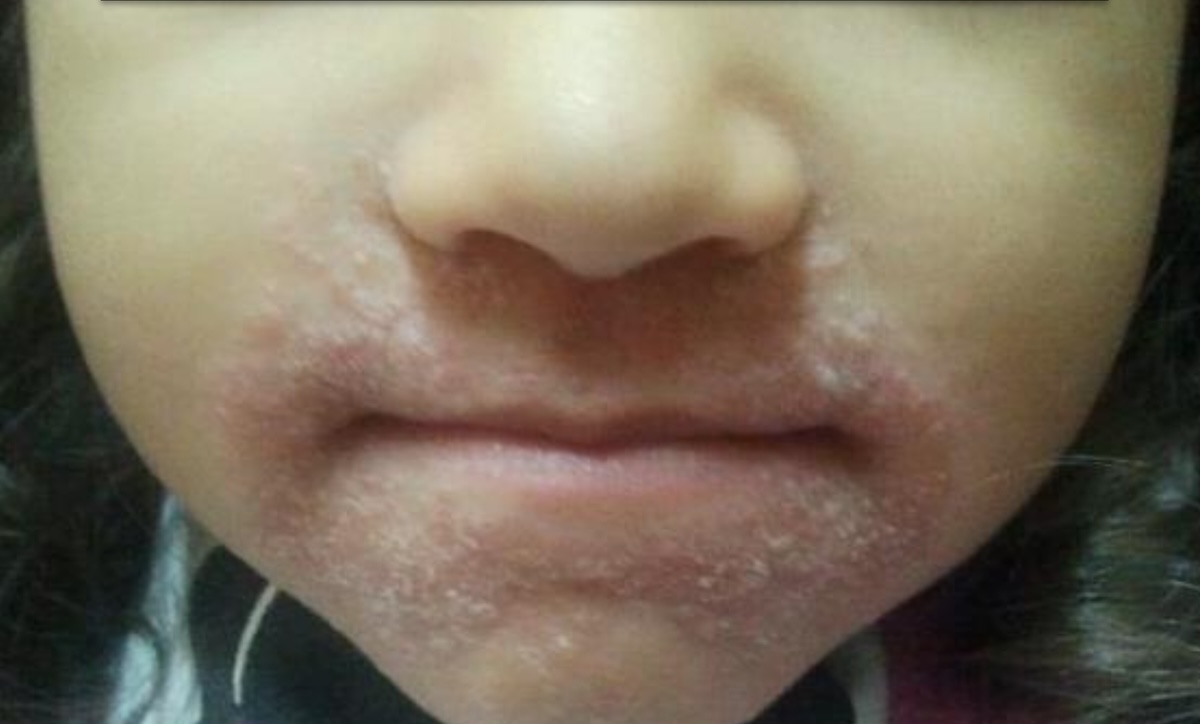 Dermatitis Perioral en la infancia: caso para tratamiento – PIEL-L ...